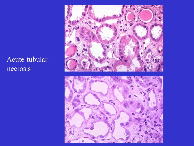 Acute tubular necrosis